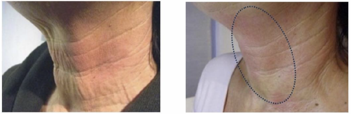 Exion™ RF Microneedling before and after — Skin Tightening